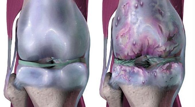 Εικόνα 2: Οστεοαρθρίτιδα γόνατος