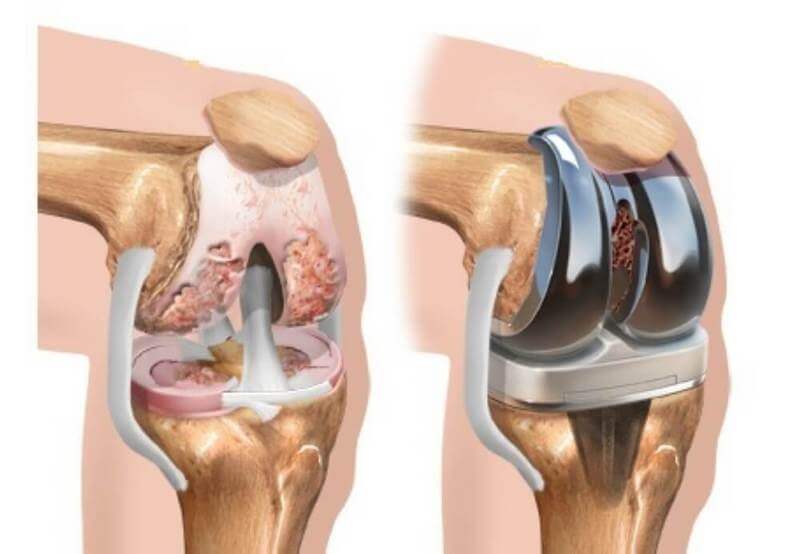 Εικόνα 3: Ολική αρθροπλαστική γόνατος