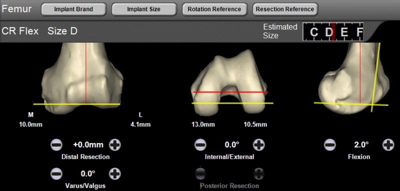 Εικόνα 7: Προεγχειρητικός σχεδιασμός κλίσεων, στροφών και συνδεσμικών τάσεων στον ηλεκτρονικό υπολογιστή.