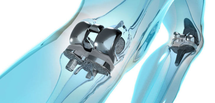 oliki arthroplastiki 13