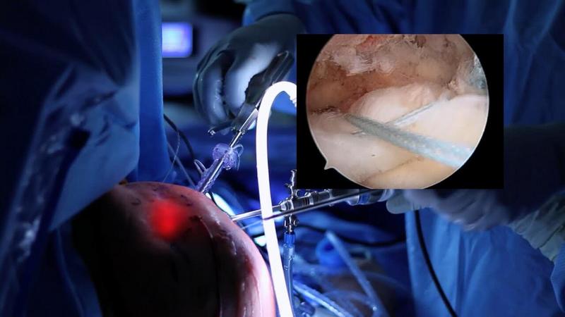 Αρθροσκοπική Συρραφή Ρήξης Υπερακάνθιου Τένοντα - Μπουρσινός Λουκάς