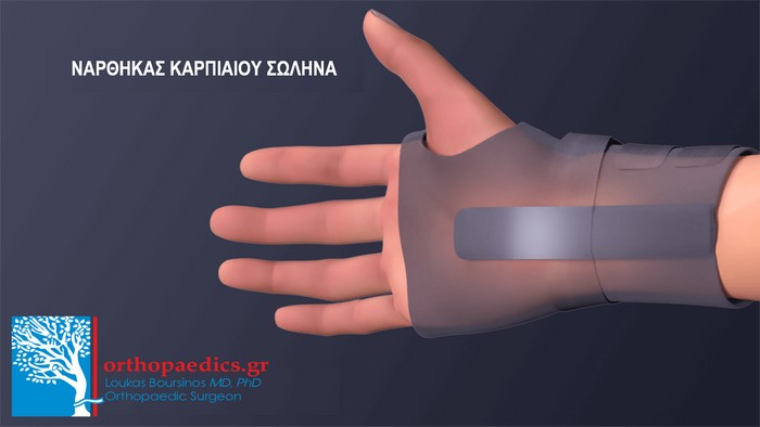 Σύνδρομο Καρπιαίου Σωλήνα