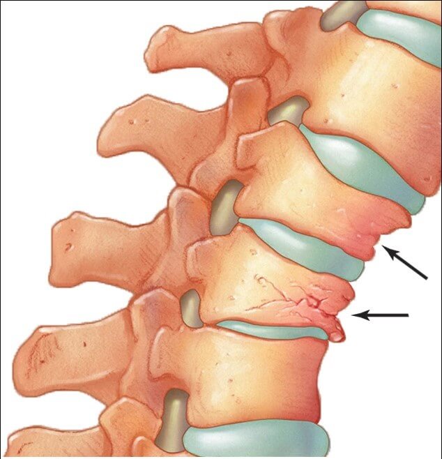 Κυφοπλαστική