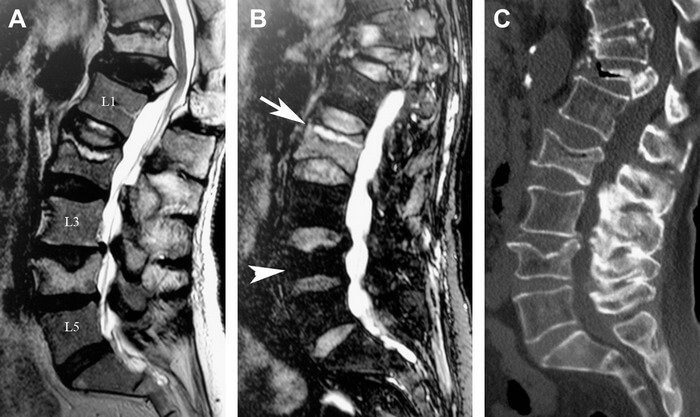 Κυφοπλαστική