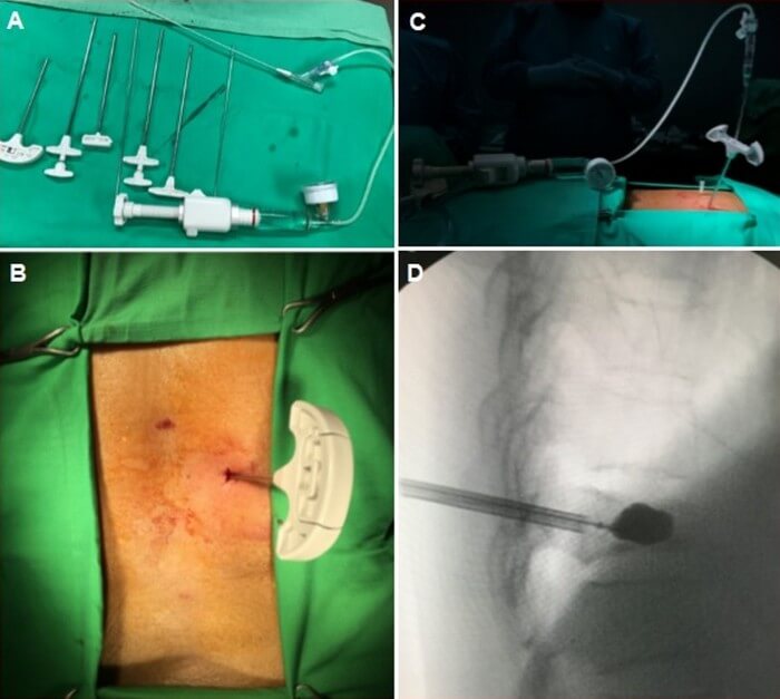 Κυφοπλαστική