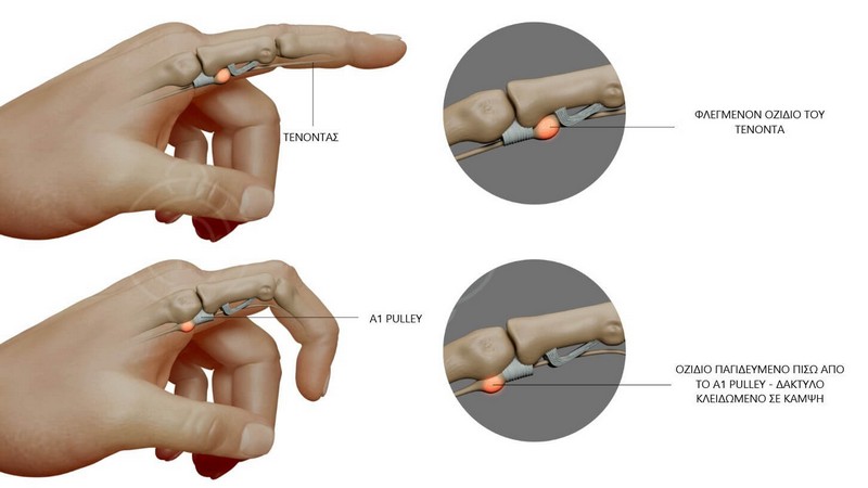 ektinasomeno daktylo 01