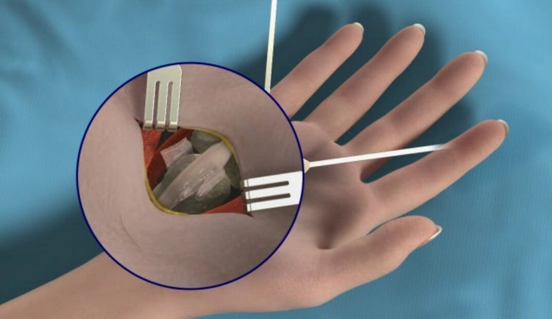 ektinasomeno daktylo 02